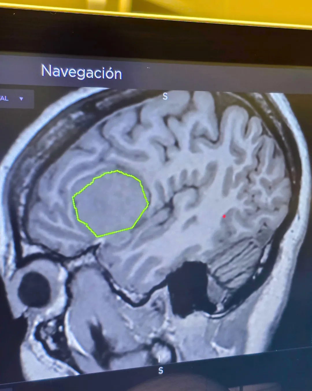 Pantalla de neuronavegación mostrando una resonancia magnética cerebral con la lesión delimitada